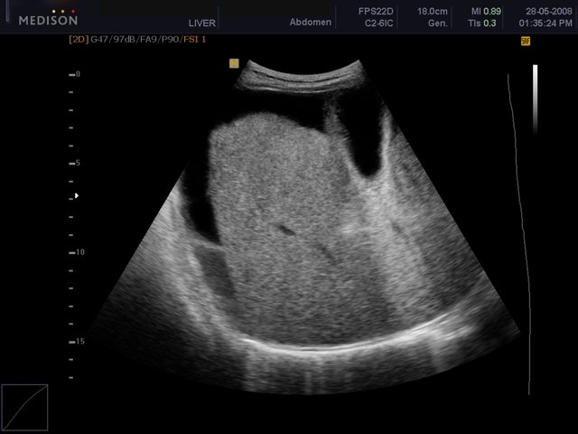 Liver ascites, B-mode (echogramm №453)