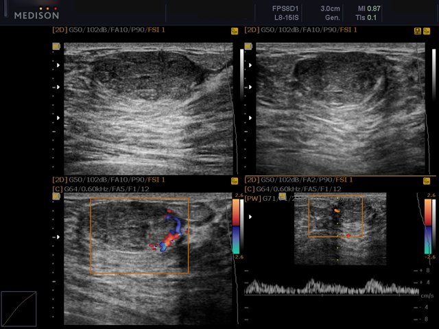 Breast mass, four-window view (echogramm №454)