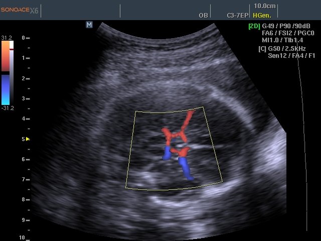 Circle of Willis, color doppler (echogramm №455)