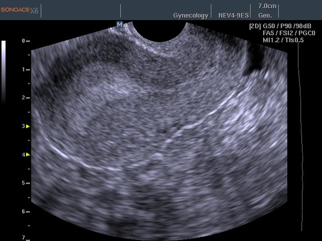 Uterus, B-mode (echogramm №456)