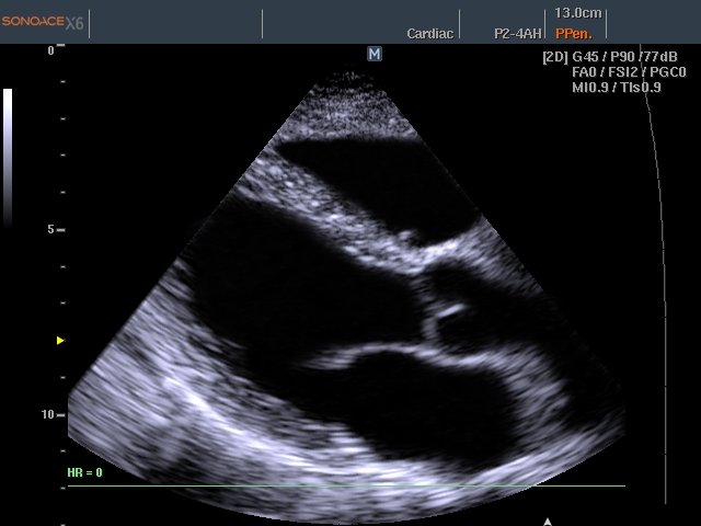 Heart (long axis of LV), B-mode (echogramm №457)