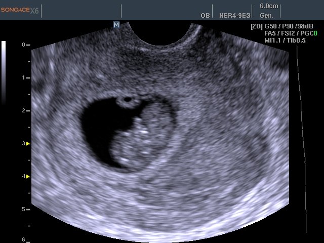 Fetus - 8 weeks, B-mode (echogramm №458)