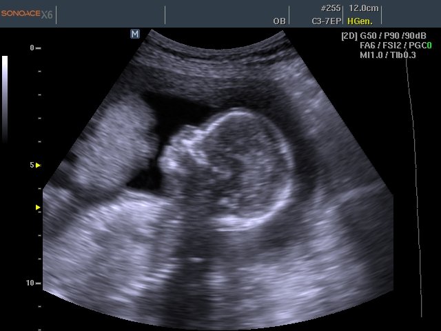 Fetal profile, B-mode (echogramm №461)