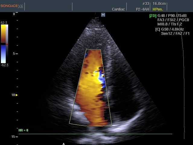 Mitral valve, color doppler (echogramm №462)