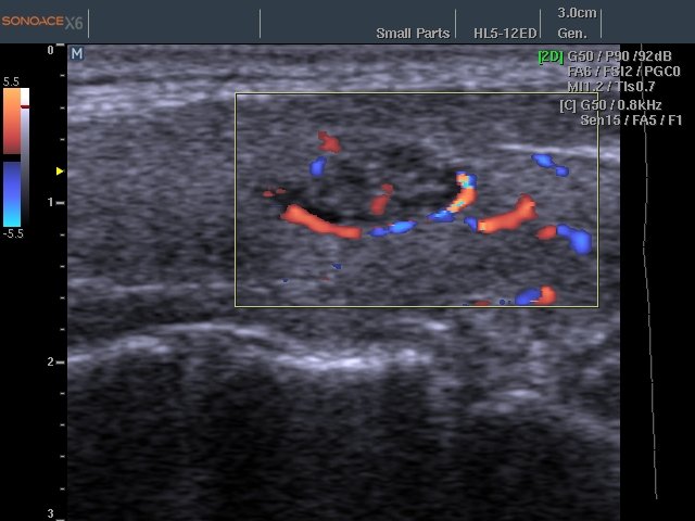 Thyroid nodule, color doppler (echogramm №463)