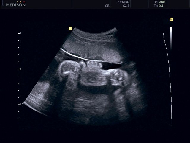 Fetus - norm, B-mode (echogramm №465)
