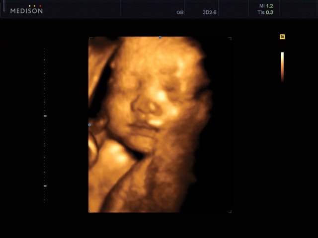 Fetal face - 25 weeks, 3D (echogramm №466)