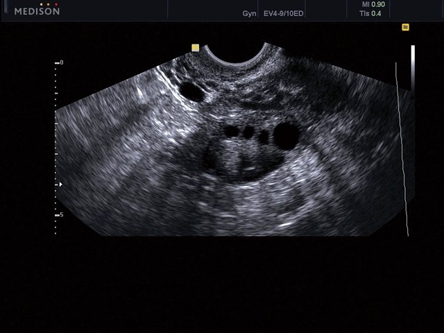Ovary, B-mode (echogramm №467)