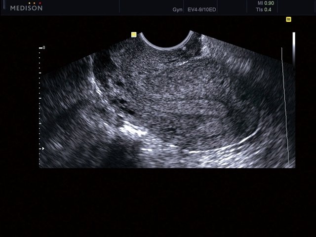 Uterus, B-mode (echogramm №469)