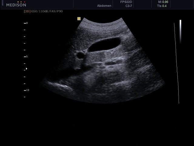 Gall bladder, B-mode (echogramm №471)