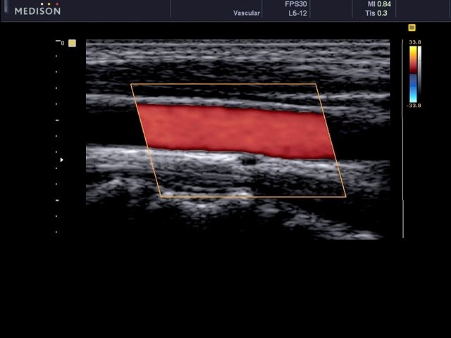 Common carotid artery, color doppler (echogramm №473)