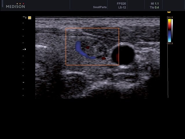 Thyroid nodule, color doppler (echogramm №474)