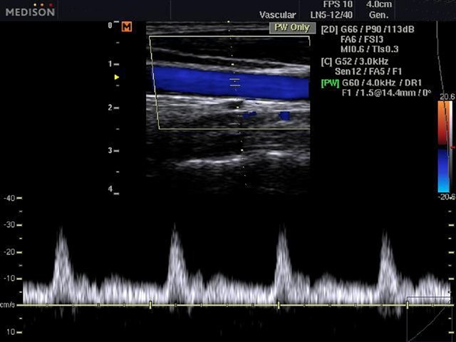 Common carotid artery, CFM & PW (echogramm №476)