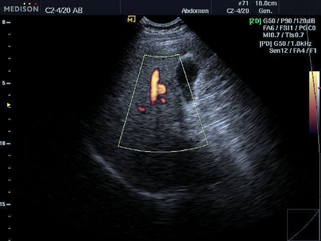 Liver, power doppler (echogramm №480)