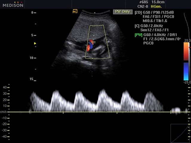 Umbilical vessels, CFM & PW (echogramm №484)