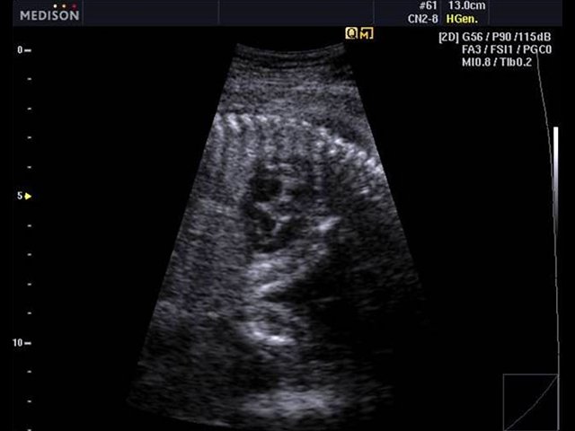 Fetal heart, Quick FSI (echogramm №486)
