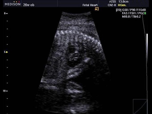 Fetal heart, B-mode (echogramm №487)
