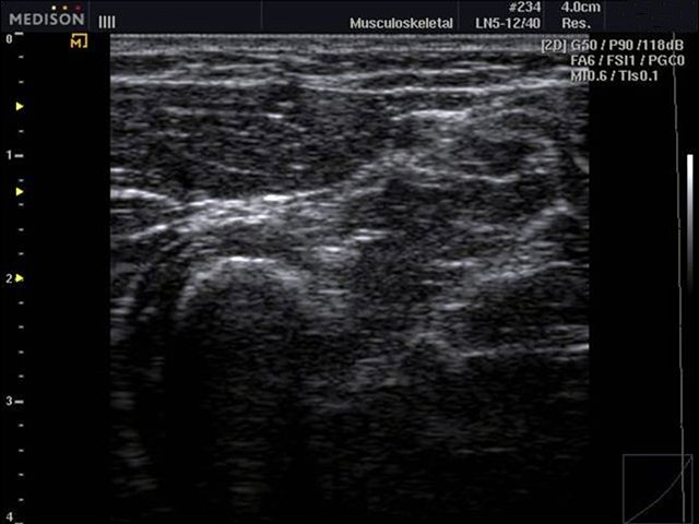 Soft tissue, B-mode (echogramm №489)