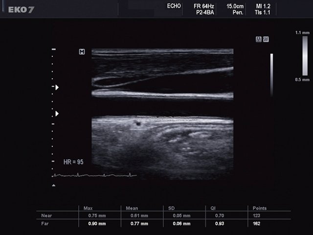 Common carotid artery, Auto IMT (echogramm №490)