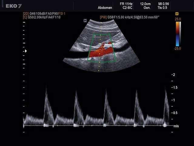 Celiac artery, CFM & PW (echogramm №494)