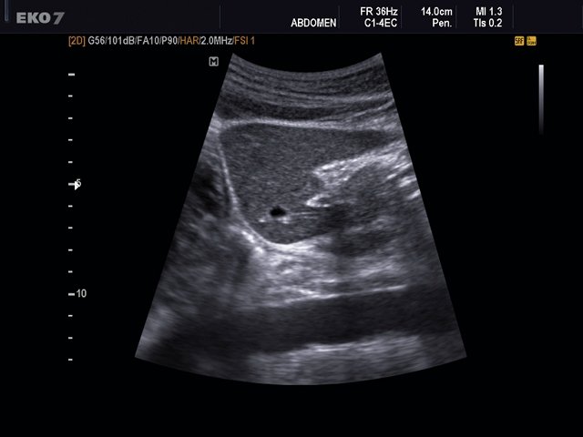 Liver - left lobe, B-mode (echogramm №496)