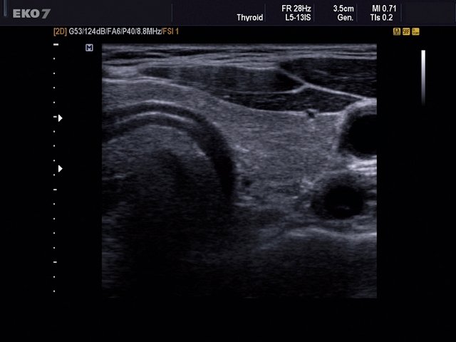 Thyroid, B-mode (echogramm №497)