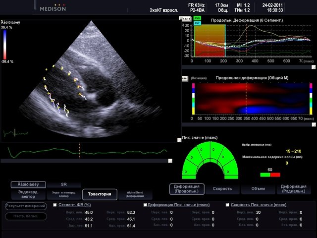 Left ventricular longitudinal, 2D Strain and acoustic markers (echogramm №501)