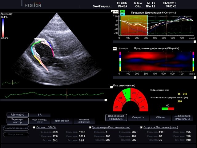 Left ventricular longitudinal, 2D Strain and endocardial vectors (echogramm №502)