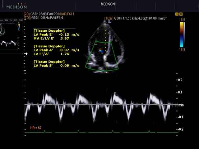 Interventricular septum, TDI spectral doppler (echogramm №503)