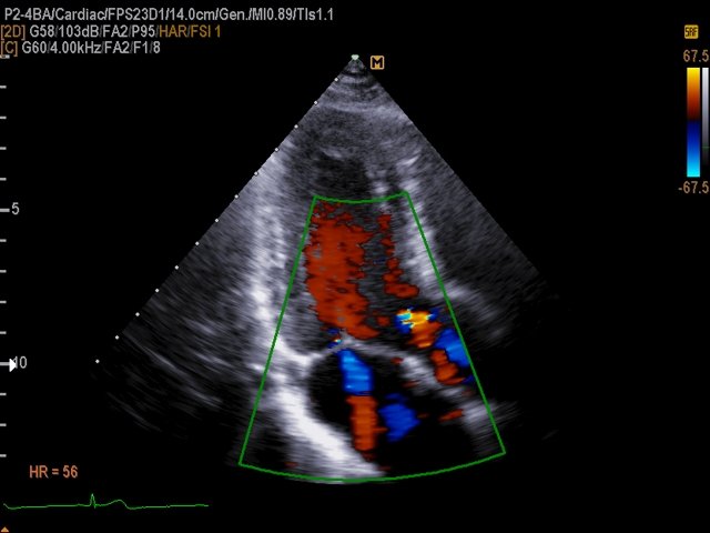 Mitral regurgitation and aortic regurgitation, color doppler (echogramm №504)
