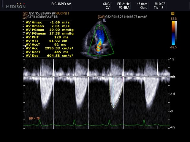 Transaortic flow, CFM & CW (echogramm №505)