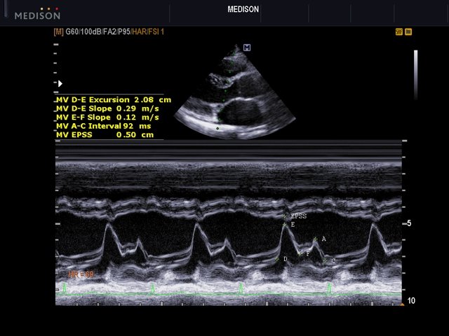 Mitral valve, M-mode (echogramm №506)