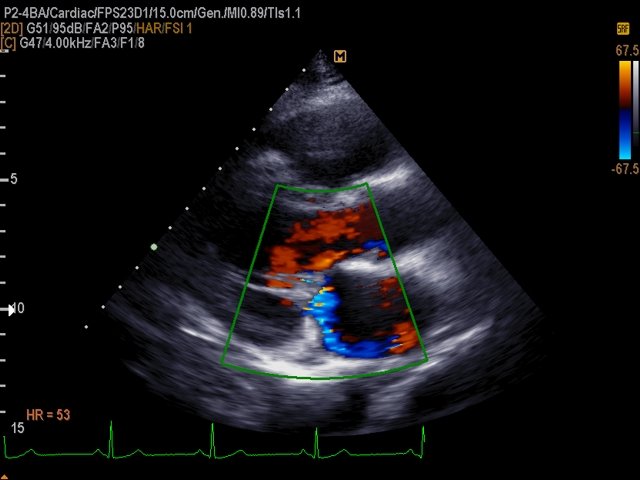 Mitral regurgitation, color doppler (echogramm №507)