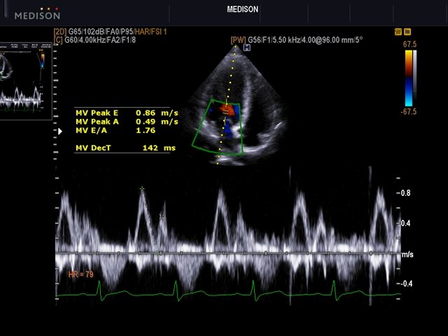 Transmitral flow, CFM & PW (echogramm №508)