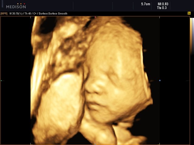 Fetal face, 3D (echogramm №510)