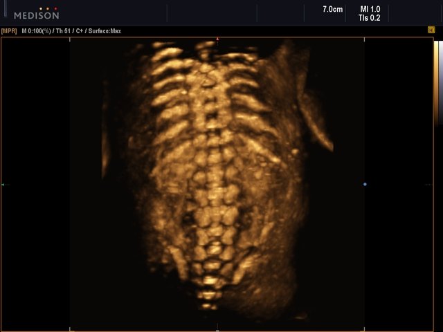 Fetal spine, HDVI, 3D (echogramm №511)