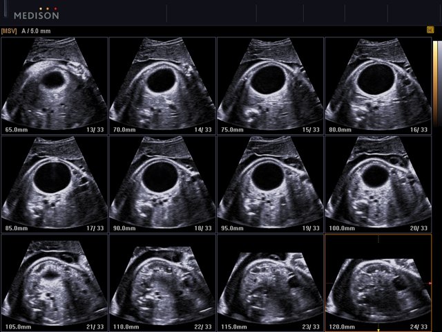 Fetus - abdominal cyst, MSV (echogramm №513)