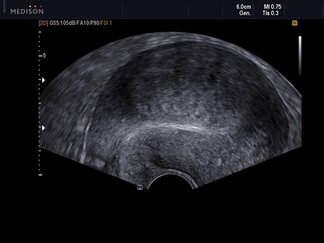 Uterine myoma, B-mode (echogramm №514)