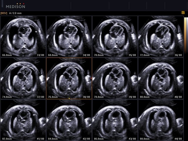 Fetus - bilateral pleural effusion, MSV (echogramm №515)