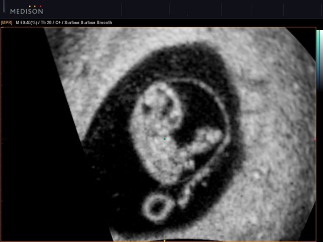 Fetus - 8 weeks, B-mode (echogramm №517)