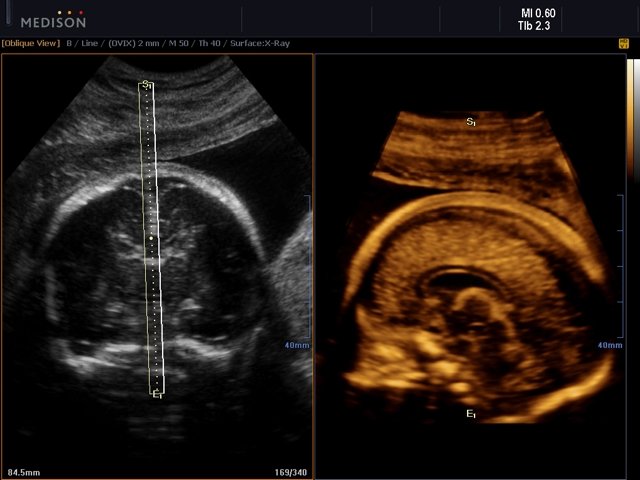 Corpus callosum of fetal brain, OVIX & 3D (echogramm №518)