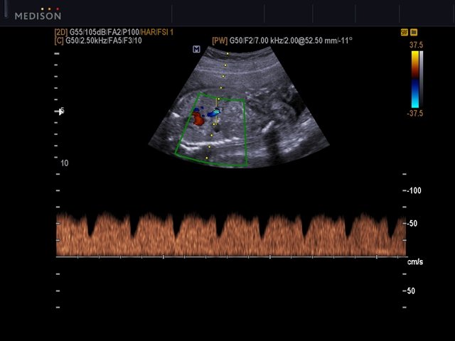 Fetal ductus venosus, CFM & PW (echogramm №519)