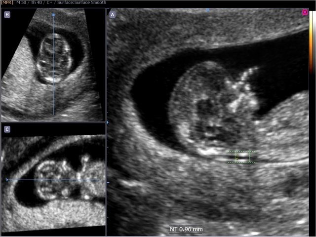 Thickness ultrasound nuchal Normal Values