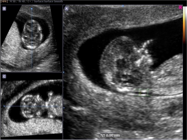 Fetus - nuchal translucency, Volume NT (echogramm №522)