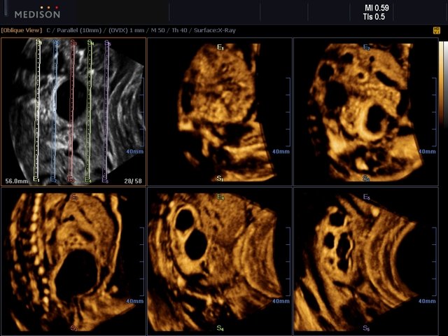 Fetus - urinary track, MSV (echogramm №523)