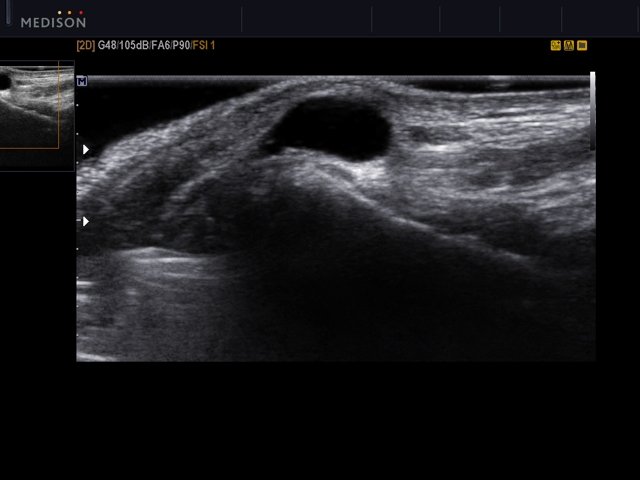 Ganglion cyst, B-mode (echogramm №525)