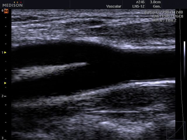 Common carotid artery, B-mode (echogramm №526)