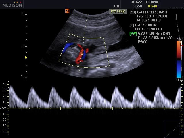 Fetus - umbilical artery, CFM & PW (echogramm №527)