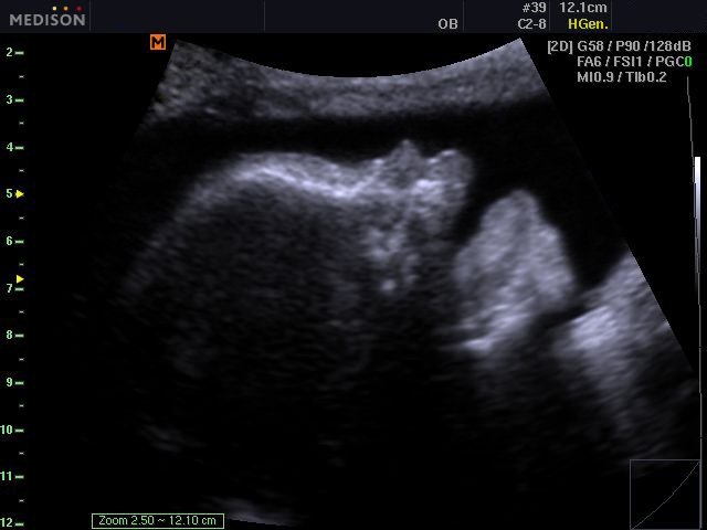 Fetal profile, B-mode (echogramm №528)