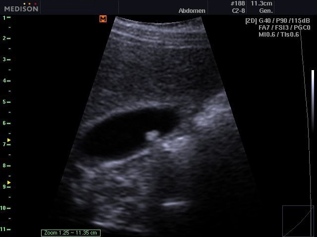 Gallbladder stone, B-mode (echogramm №529)